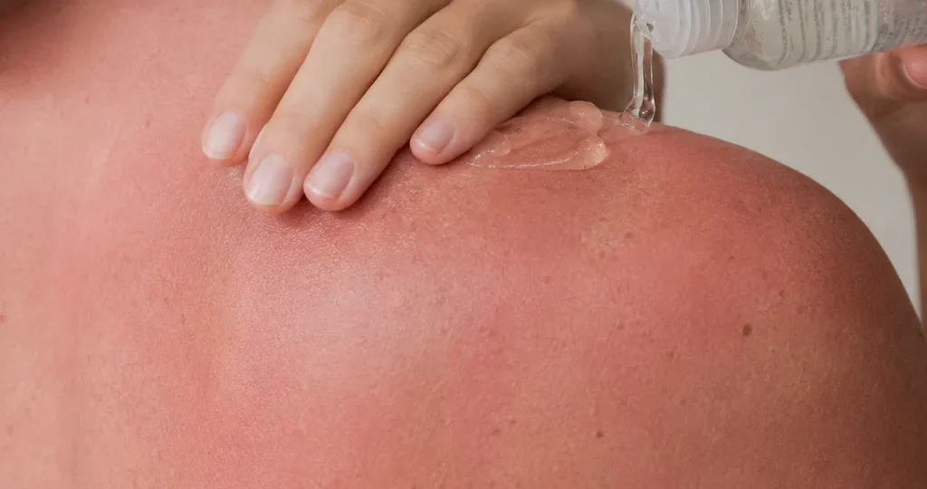 Person påfører aloe vera-gel på solskoldede skuldre som behandling af solskade